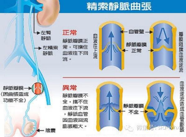 關(guān)于2021年征兵精索靜脈曲張標(biāo)準(zhǔn)的探討，2021年征兵精索靜脈曲張標(biāo)準(zhǔn)深度解析