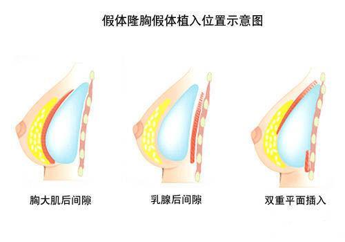怎么樣才能豐胸最有效最安全，最安全有效的豐胸方法探究