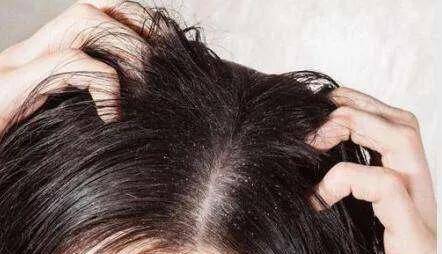 頭皮屑多怎么辦小妙招，全方位解決頭皮問(wèn)題，全方位解決頭皮問(wèn)題，頭皮屑多的小妙招匯總