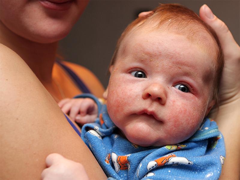 兒童常見的幾種疹子及其識別與處理方法，兒童常見疹子類型、識別與處理方法指南