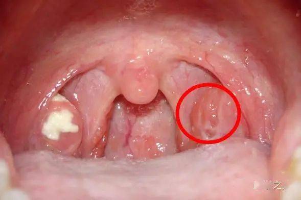 扁桃體炎化膿最快治愈法，全面解析與應(yīng)對策略，扁桃體炎化膿的最快治愈法，全面解析及應(yīng)對攻略