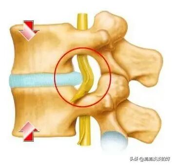 腰椎間盤突出怎么治療斷根，全面解析最佳方案，腰椎間盤突出最佳治療斷根方案解析