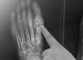 治療痛風(fēng)的最佳方法，治療痛風(fēng)的最佳方法簡介