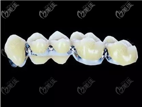 鈷鉻烤瓷牙價(jià)格解析，多少錢一顆？，鈷鉻烤瓷牙價(jià)格詳解，每顆費(fèi)用是多少？