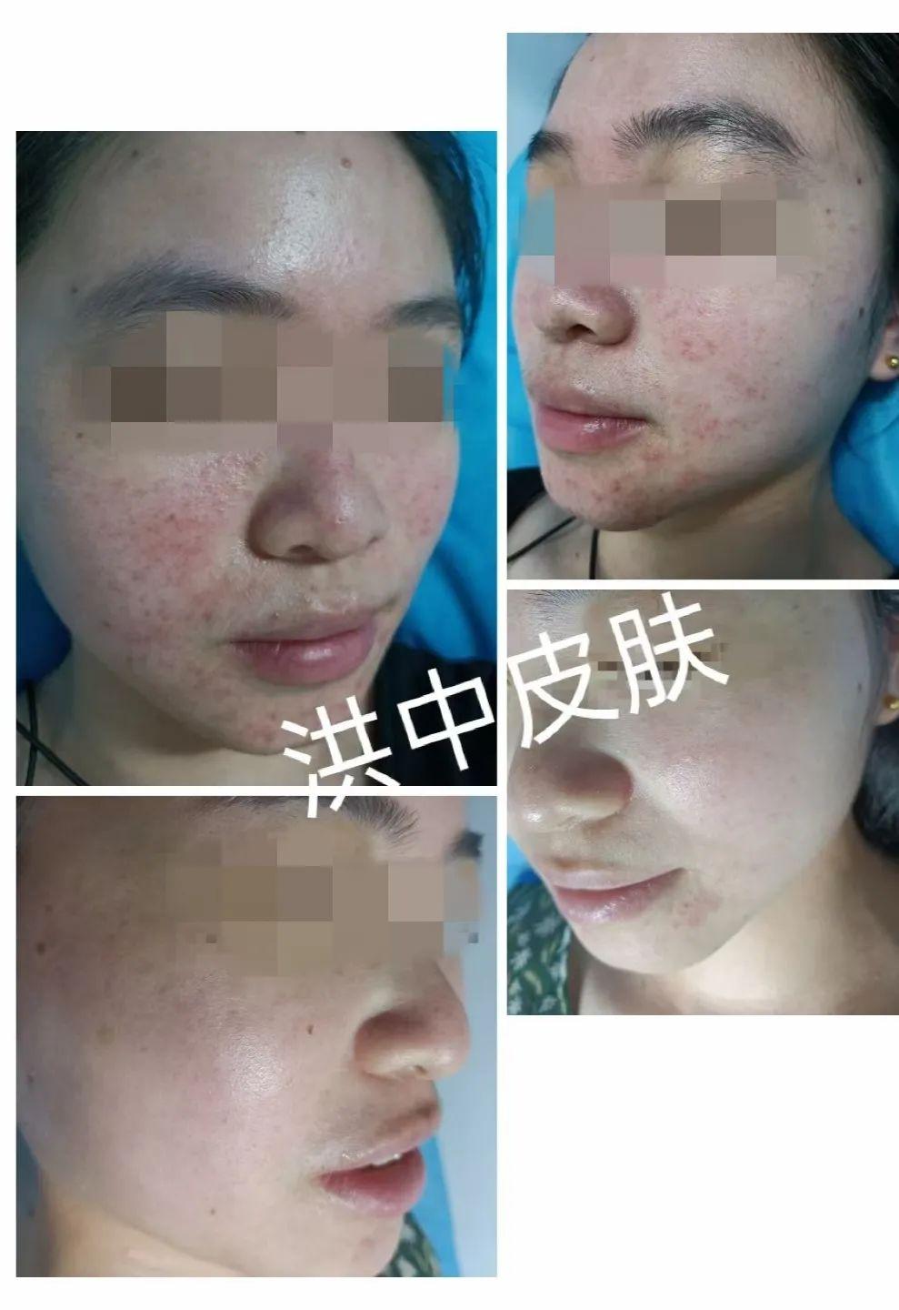 痤瘡圖片的樣子，深入了解痤瘡癥狀與表現(xiàn)，痤瘡癥狀深度解析，圖片展示痤瘡表現(xiàn)與形態(tài)