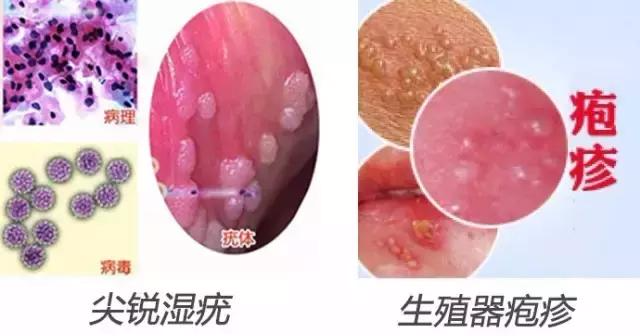 男性尖銳濕疣初期圖片及其相關(guān)解析，男性尖銳濕疣初期圖片及癥狀解析