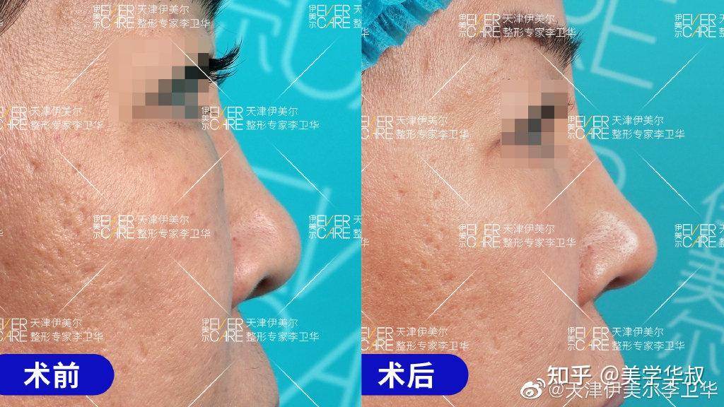 捏鼻三年，鼻頭變大——深度解析捏鼻子對鼻子的影響及應(yīng)對之策，捏鼻三年的影響，鼻頭變大原因解析與應(yīng)對之策