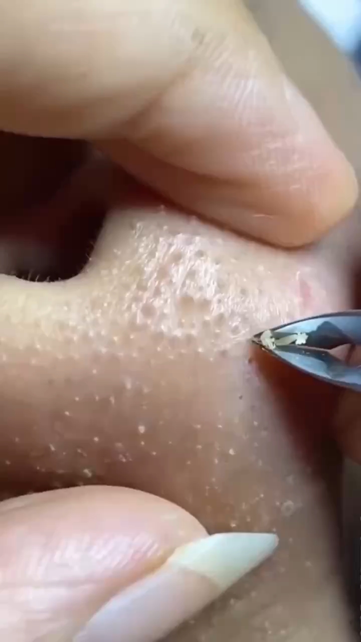 如何有效處理黑頭問(wèn)題——全方位解析黑頭成因與解決方案，全方位解析，黑頭成因探究與有效處理方案