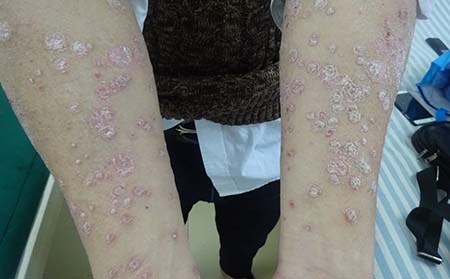 銀屑病為何被稱為窮病——深度解析，銀屑病為何被稱為‘窮病’？——深度探究其背后原因