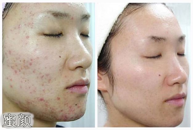 如何祛痘消除痘印——你的肌膚完美指南，完美肌膚指南，祛痘與消除痘印的方法