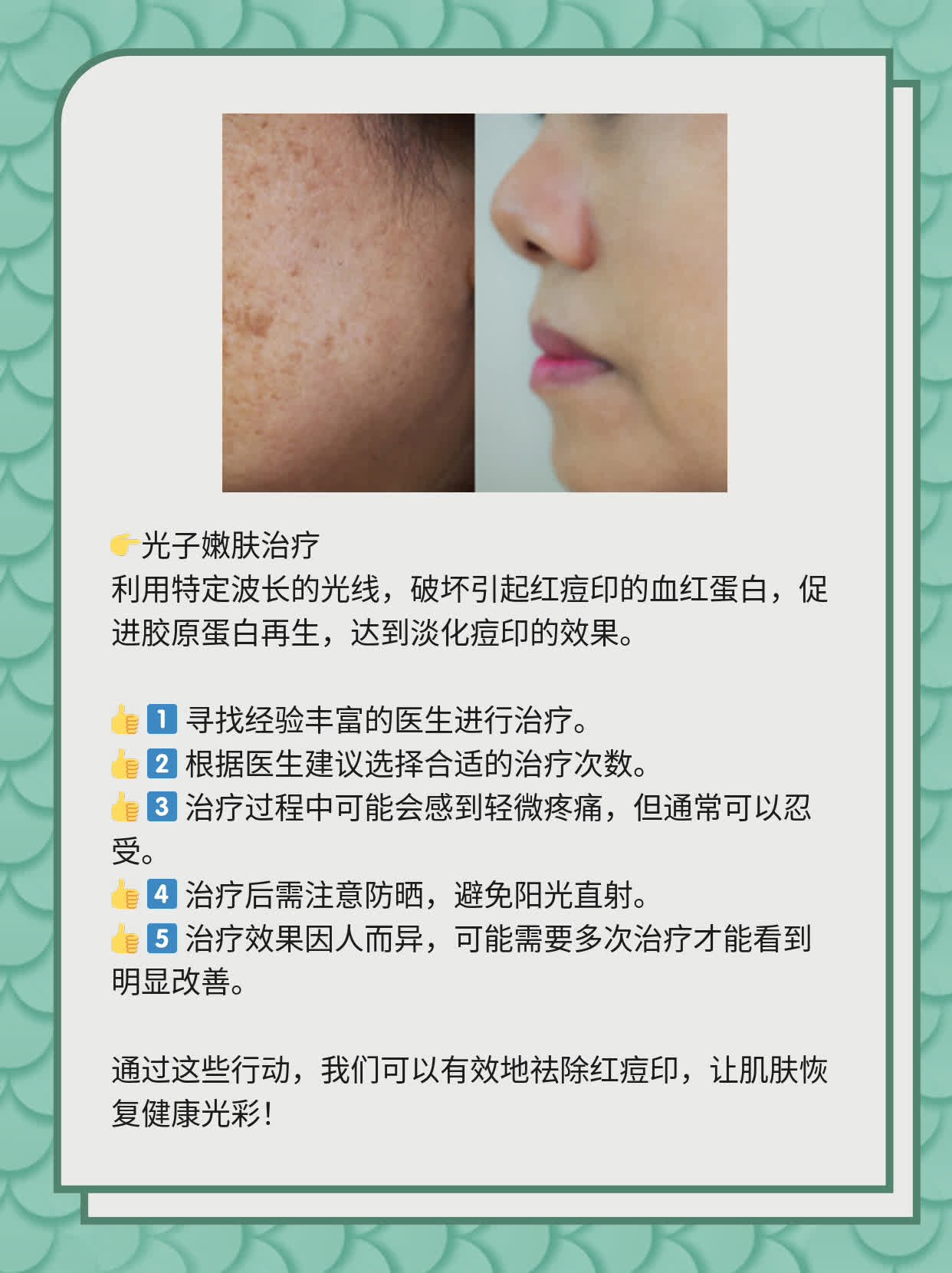 如何有效去除紅痘印，一站式解決方案，一站式解決紅痘印問題，有效去除方法大全