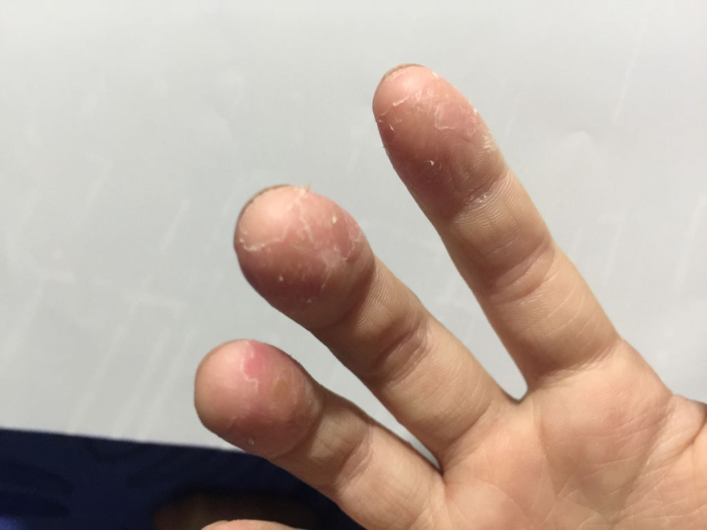 手指脫皮是什么原因，深度解析與應(yīng)對(duì)建議，手指脫皮深度解析，成因、應(yīng)對(duì)與建議