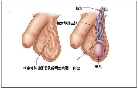 精索靜脈曲張，了解、預防與治療，精索靜脈曲張，全面解析了解、預防與治療策略