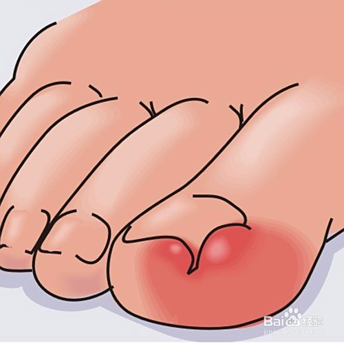 如何應(yīng)對腳趾甲長到肉里的問題——全方位解決方案，全方位解決方案，應(yīng)對腳趾甲長到肉里的困擾與挑戰(zhàn)