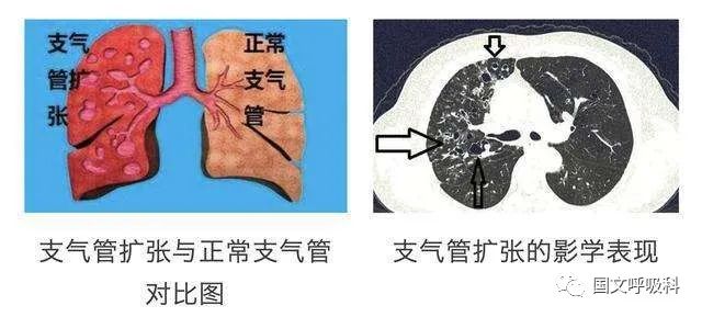 支氣管擴張，了解、預(yù)防與應(yīng)對，支氣管擴張，全面解析、預(yù)防與應(yīng)對策略