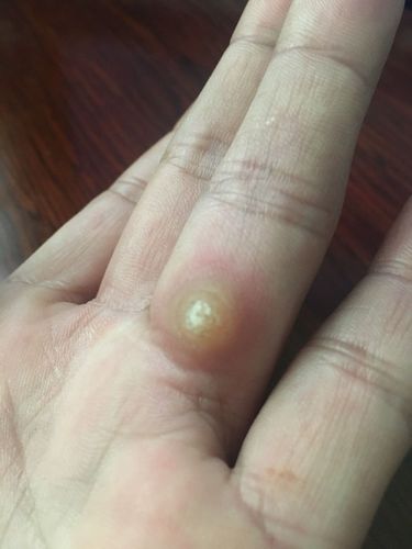 手上長雞眼初期圖片，了解、預(yù)防與治療，手上長雞眼，初期圖片、預(yù)防與治療方法全解析