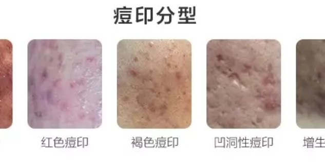 怎樣去痘印效果最好的方法，揭秘最佳去痘印方法，告別臉部瑕疵！