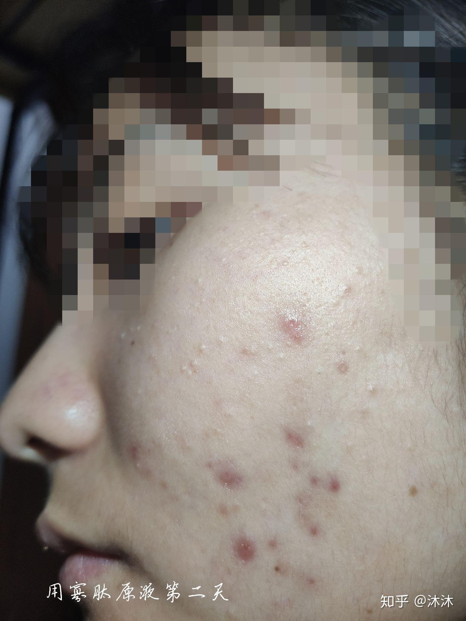 臉上起痤瘡怎么根除，全面解析與有效方法，全面解析，根除痤瘡的有效方法與日常護理建議