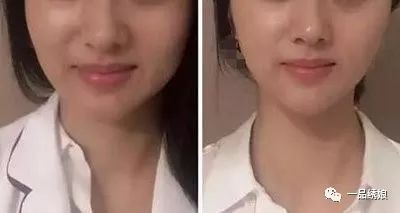 瘦臉針打三次就可以永久定型了嗎？深度解析瘦臉針效果與注意事項，深度解析，瘦臉針效果及注意事項——打三次能否永久定型？