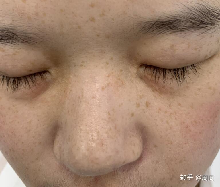 如何淡化雀斑最有效，綜合方法與日常護(hù)理，如何有效淡化雀斑，綜合方法與日常護(hù)理全解析