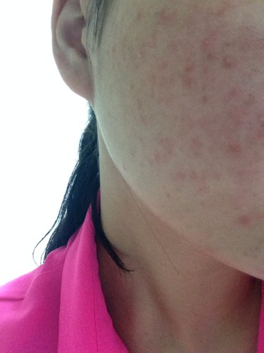 臉上突然長(zhǎng)了好多紅色的痘痘，原因、治療與預(yù)防，臉部紅色痘痘，成因、治療與預(yù)防措施