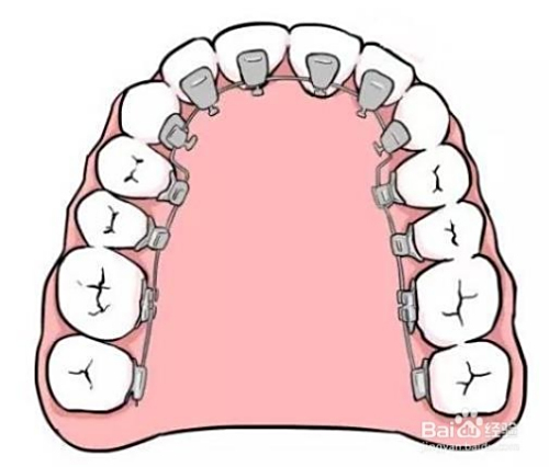 牙套價格詳解，裝一個牙套需要多少錢？，牙套價格全解析，裝牙套需要多少錢？