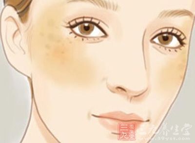 怎樣祛除黃褐斑最有效的方法，最有效的黃褐斑祛除方法