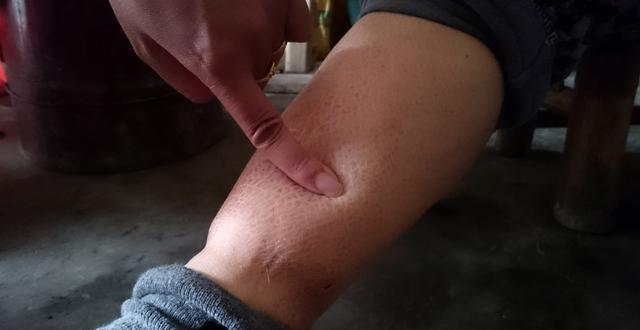 小腿浮腫一按一個(gè)坑，原因、治療與預(yù)防，小腿浮腫原因、治療及預(yù)防方法，一按一個(gè)坑的困擾