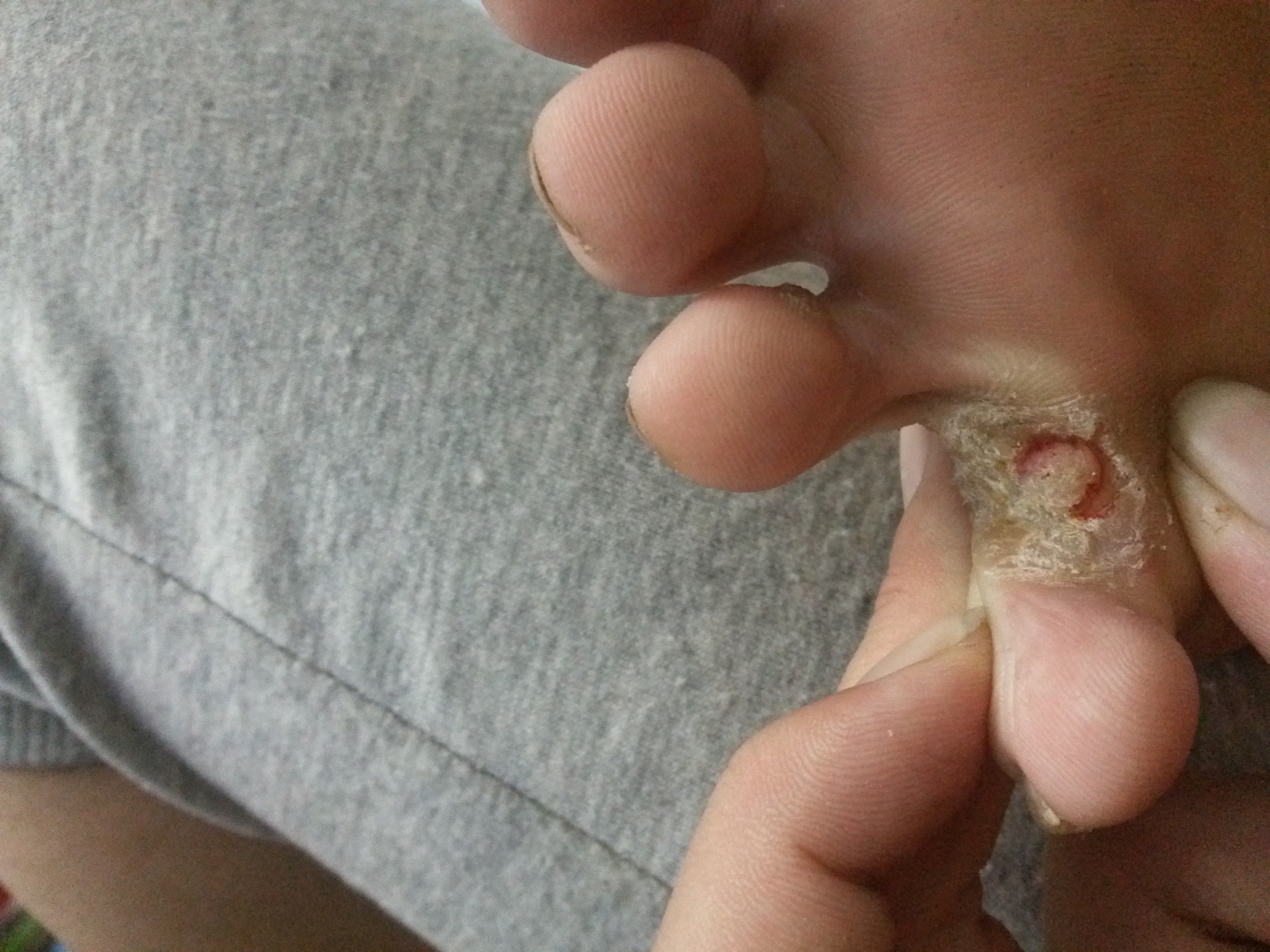 腳上怎么分辨是濕疹還是腳氣——一篇文章帶你了解二者的區(qū)別，腳上濕疹與腳氣如何區(qū)分？一篇文章詳解二者區(qū)別。