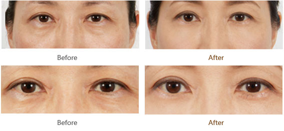 去眼袋手術全過程視頻解析，去眼袋手術全過程詳解視頻指南