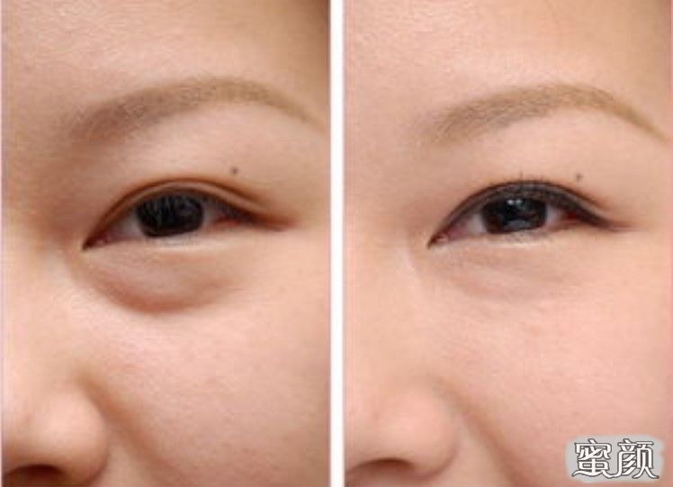 如何消除眼袋，簡單實用的方法，消除眼袋的實用方法與技巧
