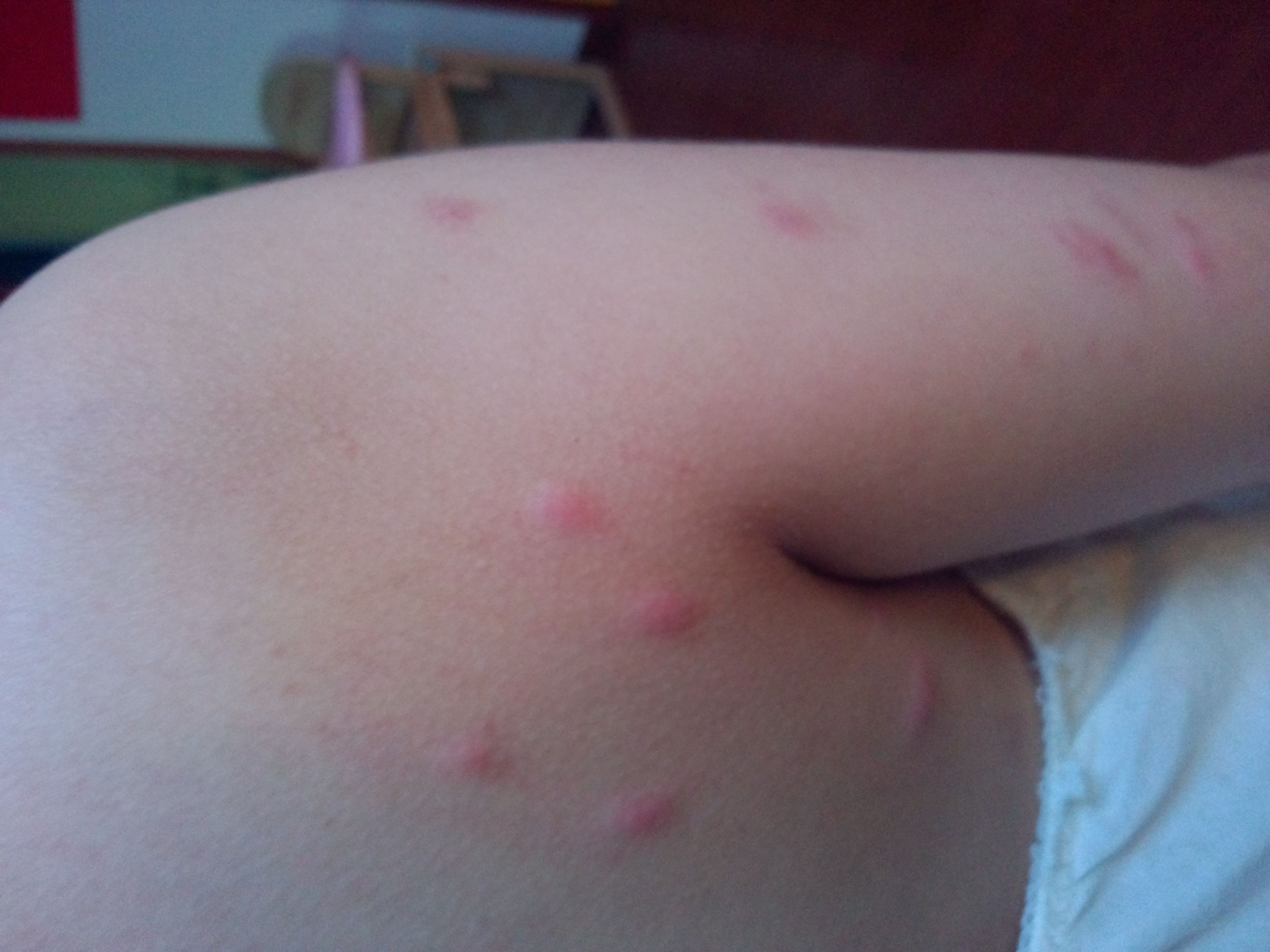 身上紅疙瘩圖片對(duì)照，了解皮膚問題的真相，身上紅疙瘩圖片對(duì)照，揭示皮膚問題真相