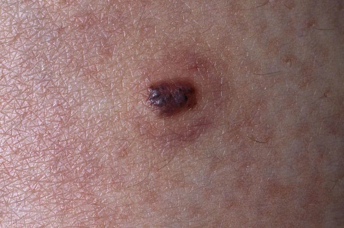 血痣和紅痣的區(qū)別圖片，深入了解兩種皮膚狀況，血痣與紅痣的區(qū)別詳解，專業(yè)圖片解析，深入了解兩種皮膚狀況特征