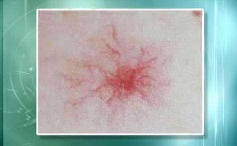 肝癌身上出現(xiàn)紅點(diǎn)圖片，癥狀解析與關(guān)注，肝癌身上紅點(diǎn)解析，癥狀、圖片及關(guān)注重點(diǎn)