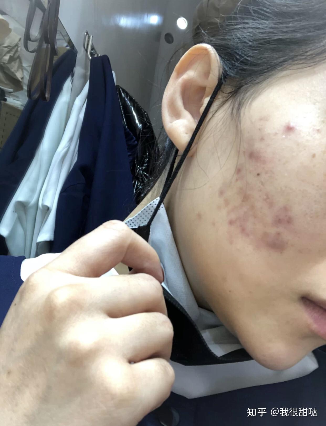 怎樣去除青春痘及痘印，全面解析有效方法，全面解析，青春痘與痘印的去除有效方法