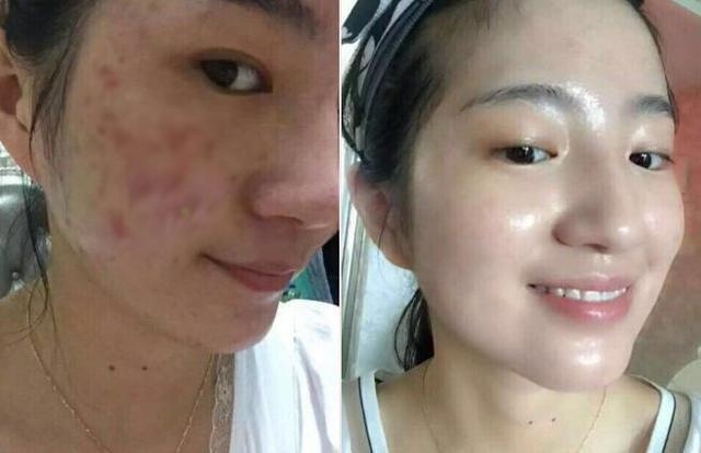 痘印多久會(huì)自己消失？全面解析痘印消失時(shí)間與影響因素，痘印消失時(shí)間全面解析，影響因素與消失時(shí)長探討