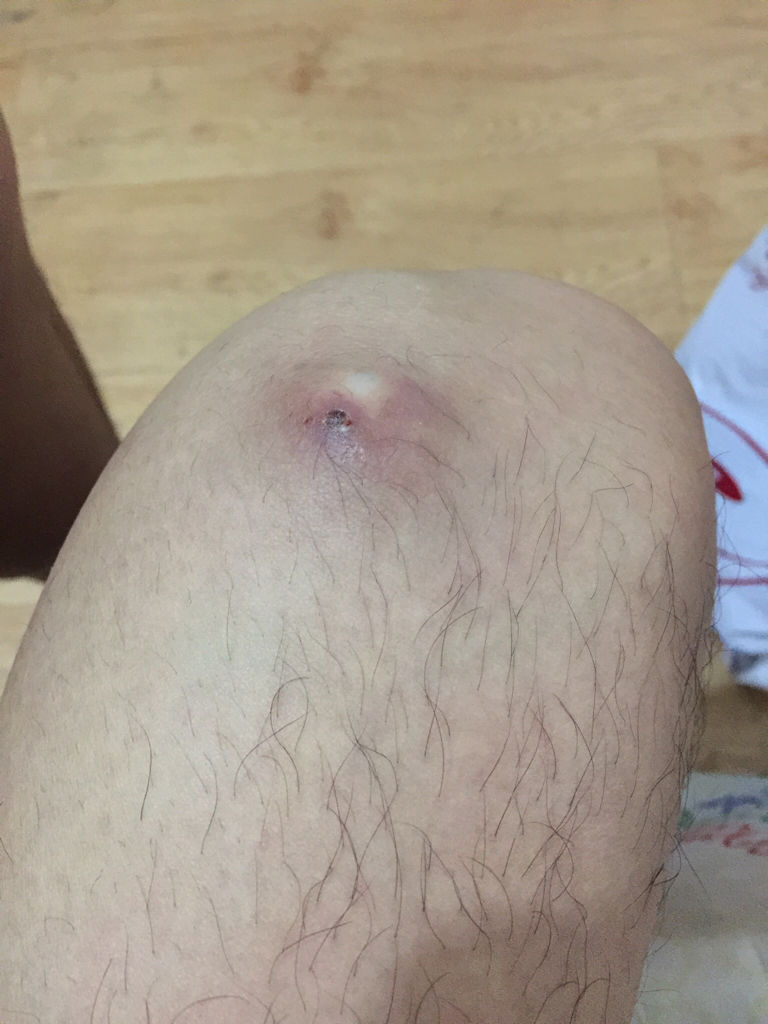 痘痘長不出來，肉里硬硬的，原因解析與應(yīng)對建議，痘痘無法冒出表面，內(nèi)部硬結(jié)成因解析及應(yīng)對之策