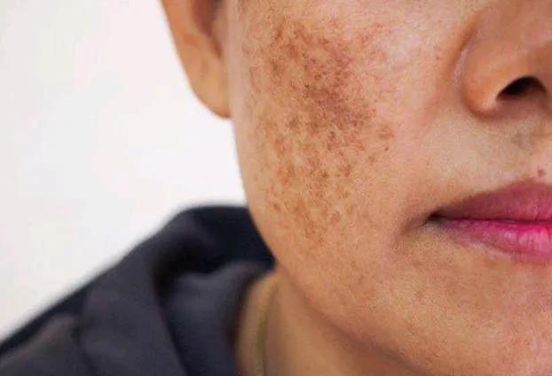 最簡單除老年斑的偏方，最簡單有效的老年斑去除偏方